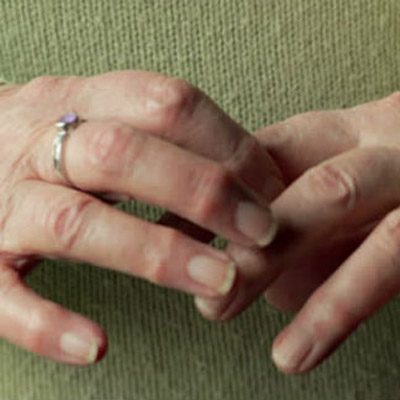 arthritis hands