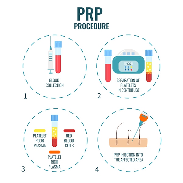 PRP Treatment Procedure in Johnstown, CO